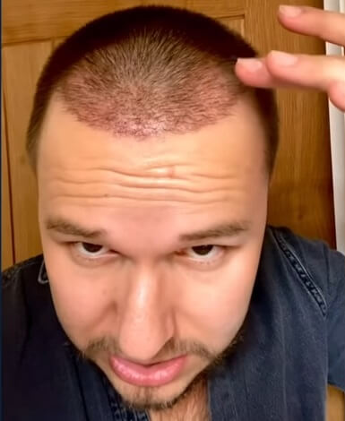 FUE hair transplant 2 weeks after surgery