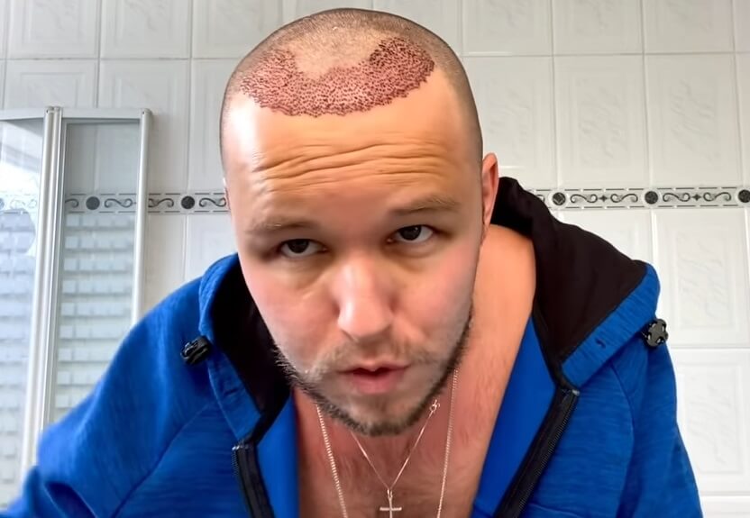 FUE hair transplant 5 days after surgery