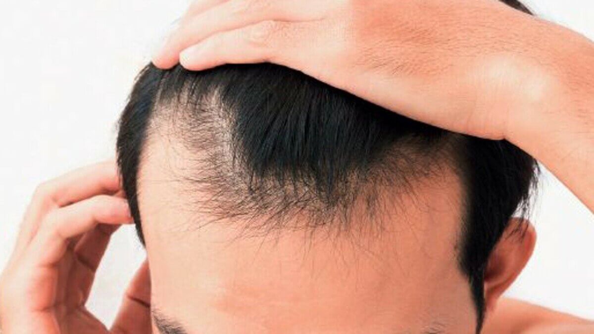 Uneven Hairlines Why It Happens and How to Fix It
