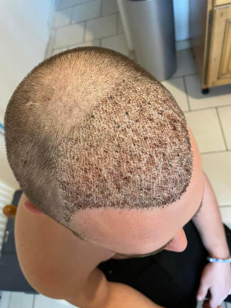 unitedcare hair transplant right after the surgery