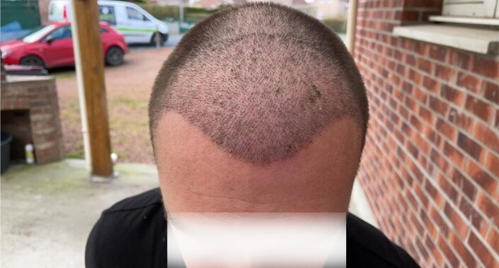 unitedcare hair transplant 6 weeks after the surgery