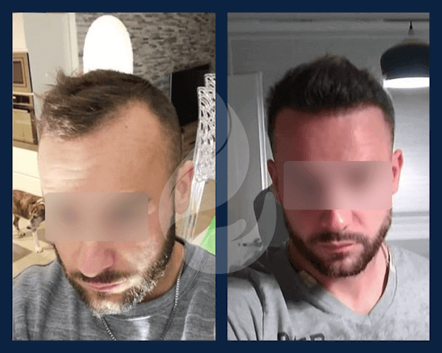 Фотографии до и после трансплантации волос с применением Финастерида
