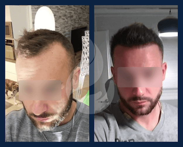 Vorher-Nachher-Fotos einer Haartransplantation mit Finasterid