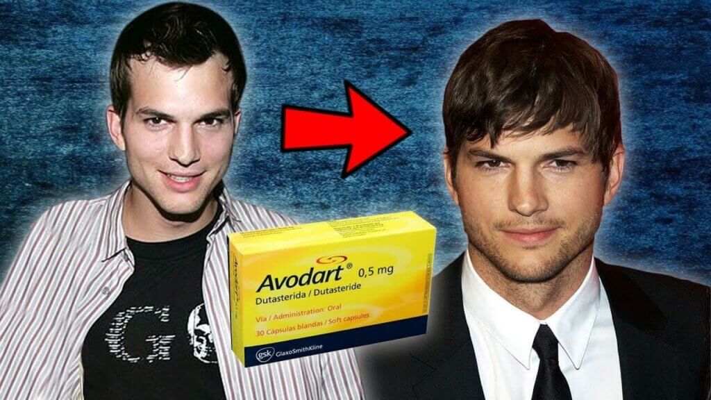 Famous Actor Who Uses Finasteride With Hair Transplant