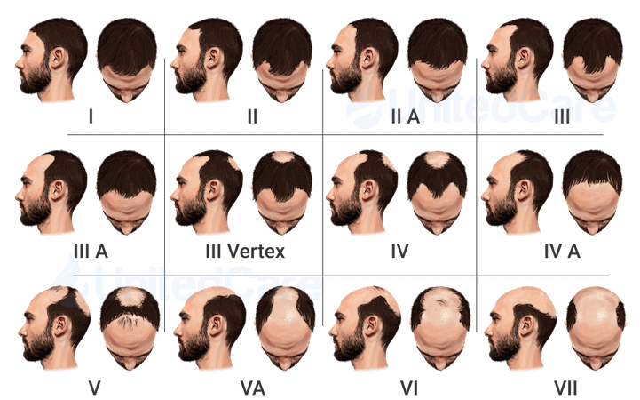 Hair Loss Progresion without Finasteride
