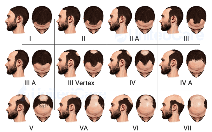 Norwood-Hamilton Scale of Male Pattern Baldness