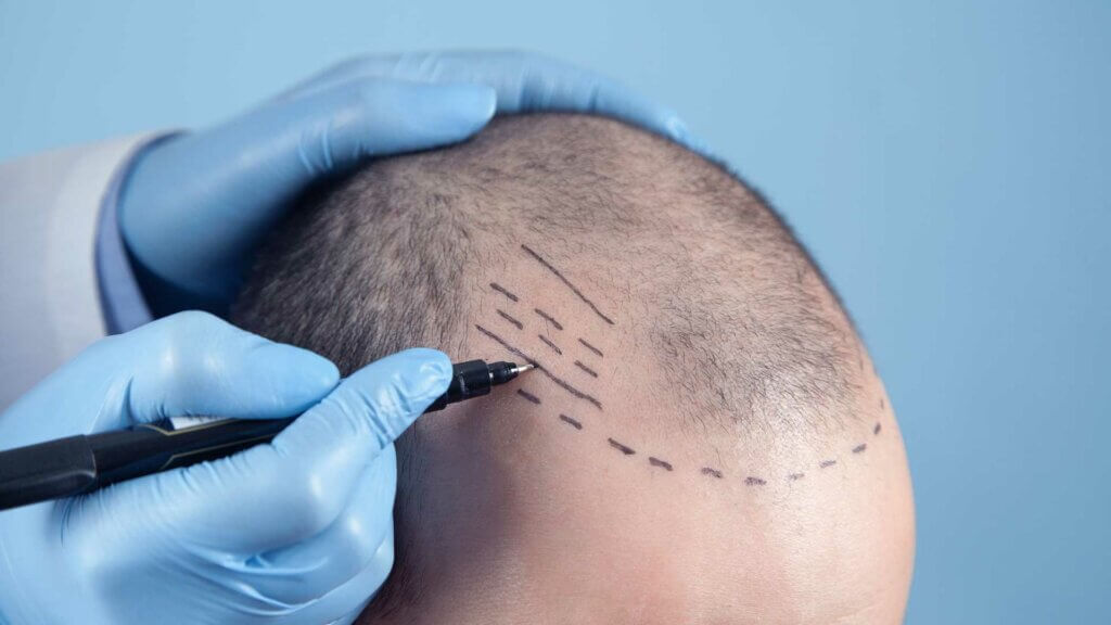 Hair transplant