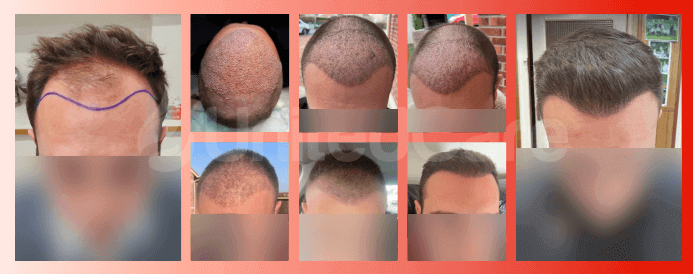 Haartransplantationsergebnisse mit Finasterid bei UnitedCare