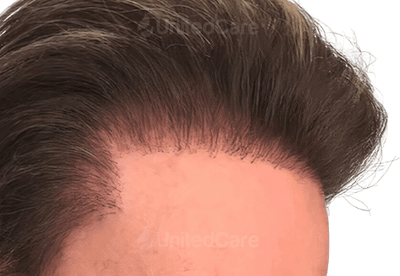 Неестественная линия волос после пересадки волос из-за вертикальной имплантации