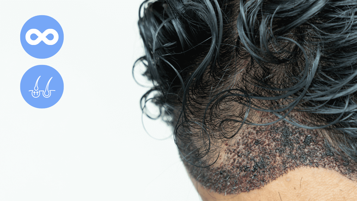 How exactly many hair transplants can a person have