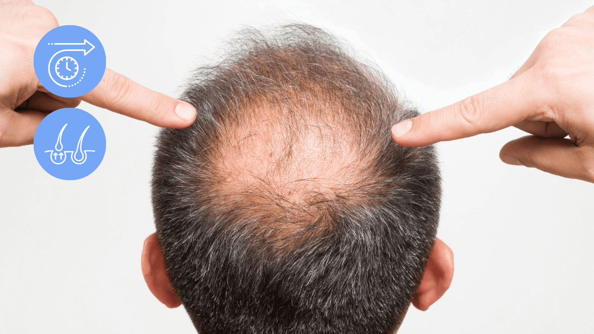 Who should and shouldn't get a hair transplant