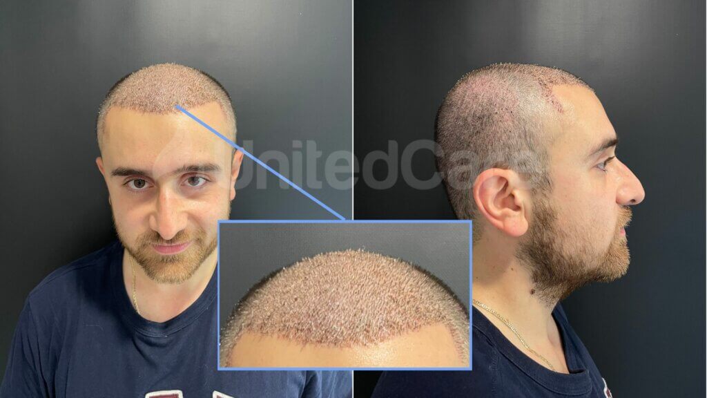 hair transplant 1 month result