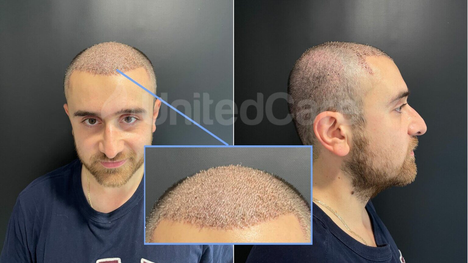 Hair transplant trypophobia