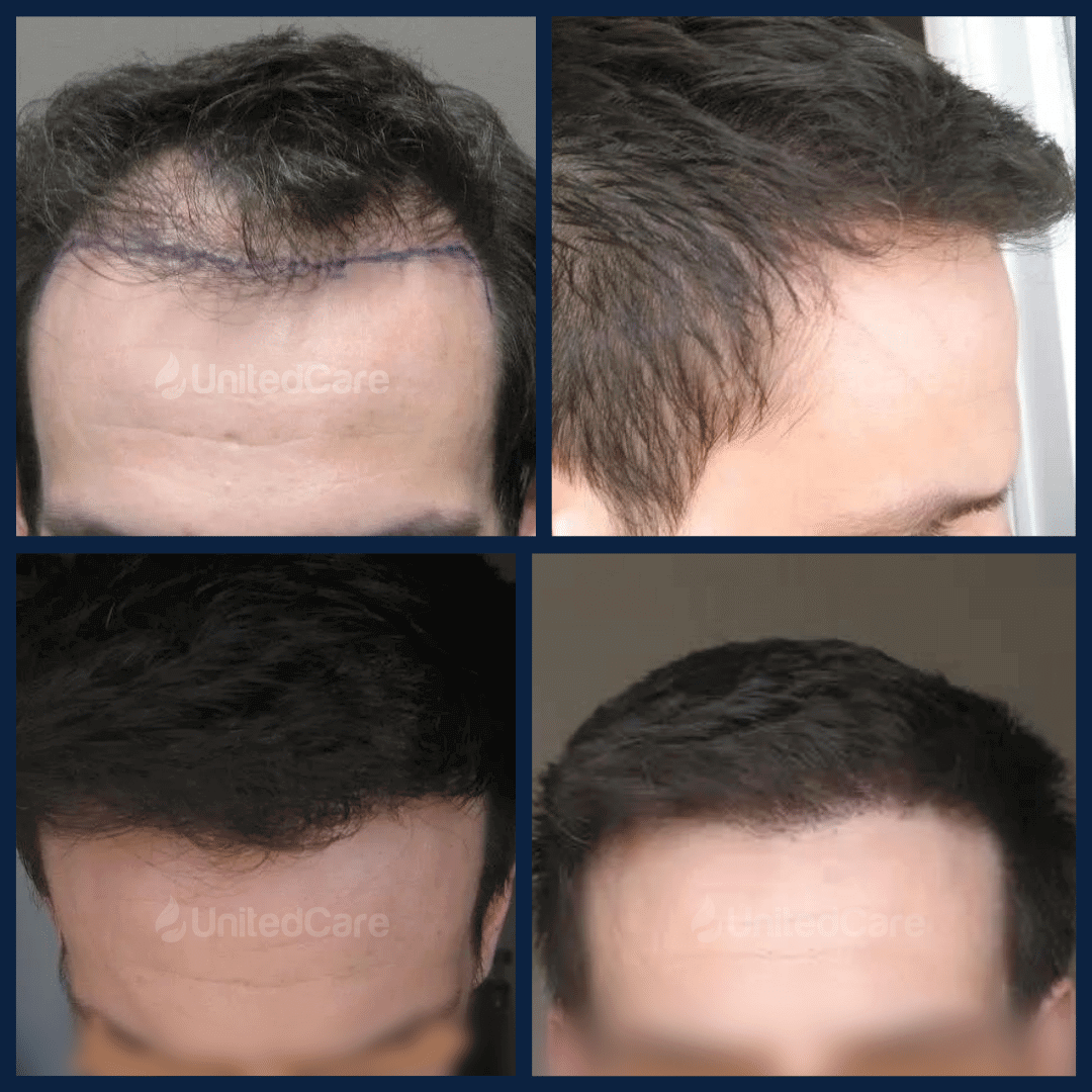 пересадка волос - до и после-2