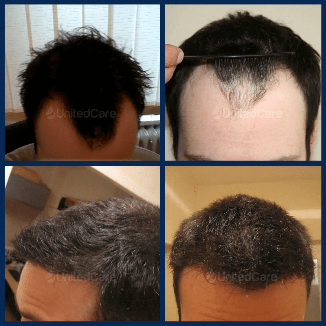 пересадка волос - до и после-3