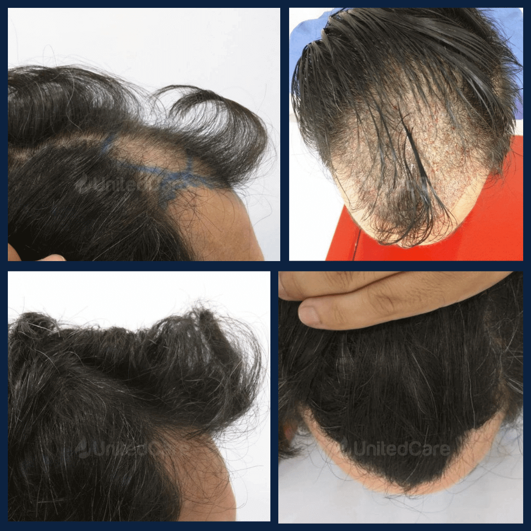 пересадка волос - до и после-4