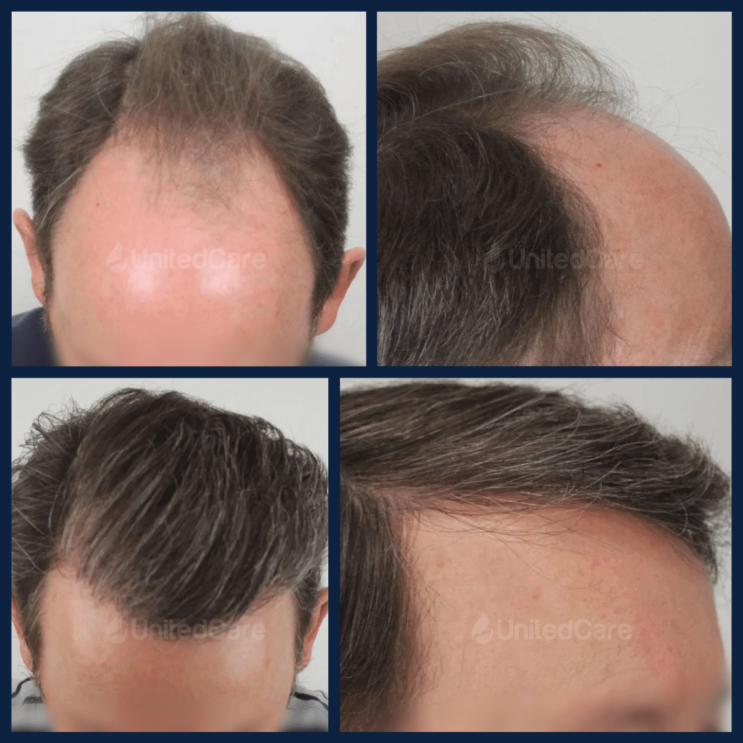 пересадка волос - до и после-5