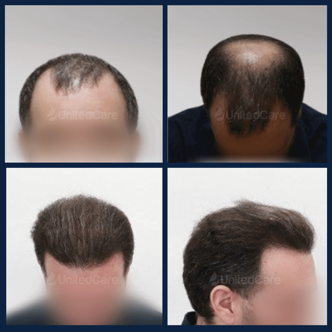 Haartransplantation-vorher-nachher-6