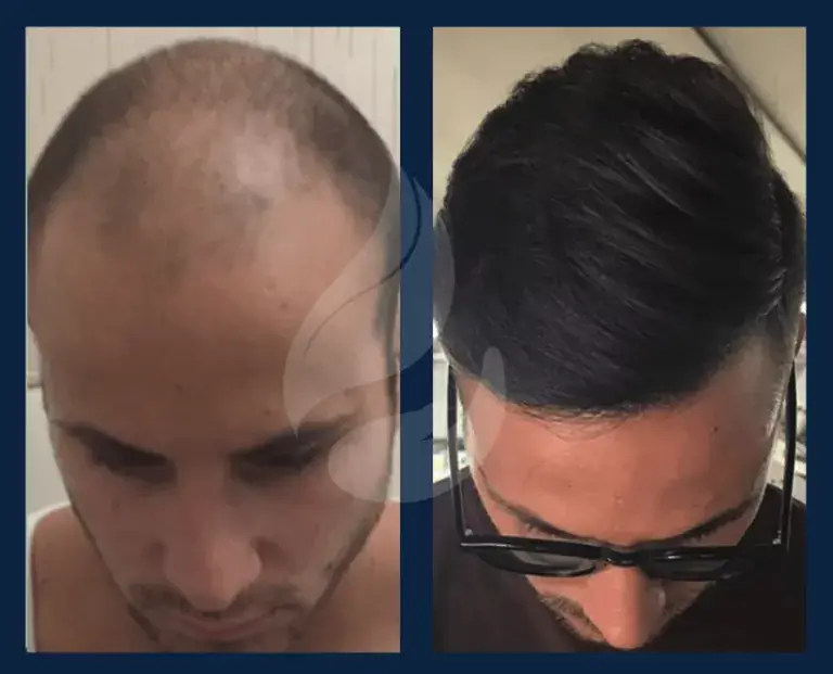 Before and after a hair transplant in UnitedCare