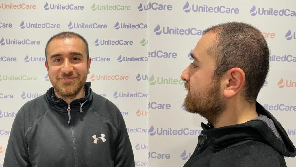 unitedcare clinic hair transplant progression