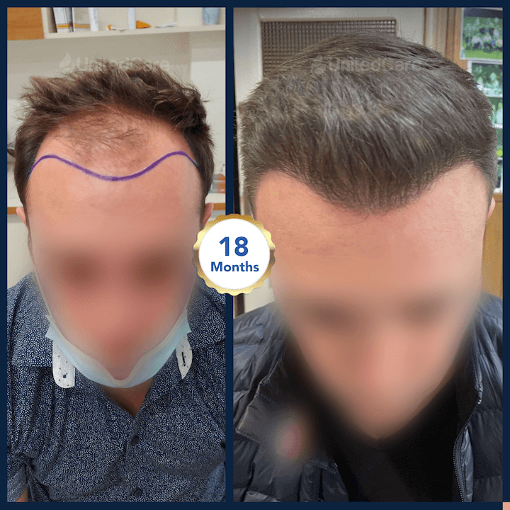 Haartransplantation vorher nachher