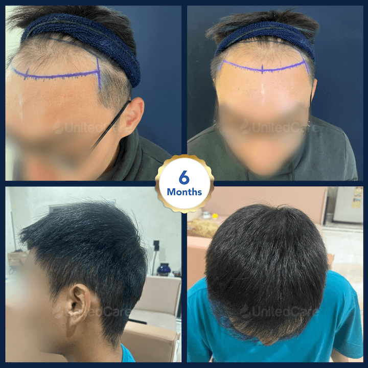 Haartransplantation vorher nachher