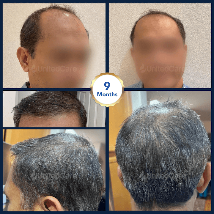 Haartransplantation vorher nachher