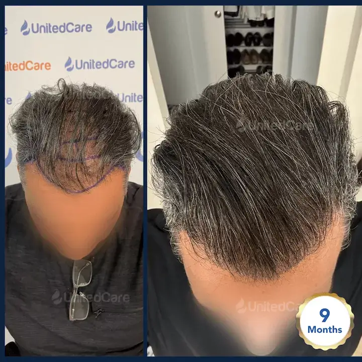 Hair transplant results with before and after UnitedCare