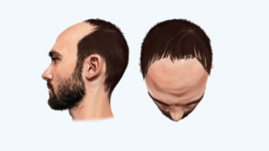 Male Pattern Baldness: Identification, Causes,Treatment, and Patterns