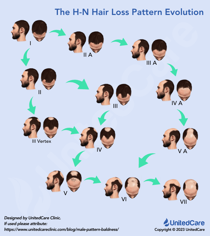 hamilton norwood hair loss pattern-evolution paths