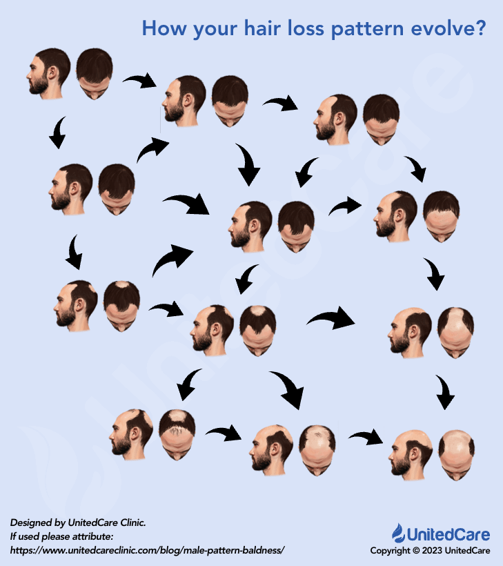 Hamilton Norwood scale possible hair loss evolution patterns