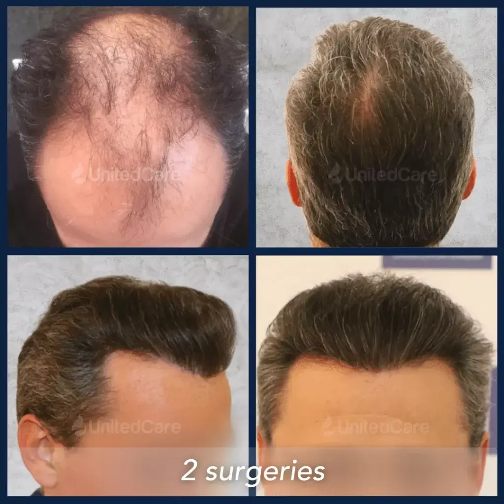 Hair transplant results with before and after UnitedCare