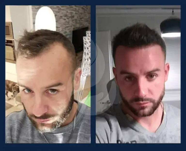 Before and after photo of a UnitedCare patient with a short hair cut