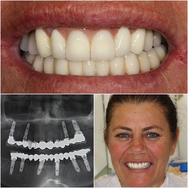 A patient from Istanbul Dental Care