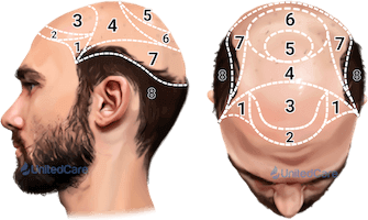 scalp-hair-transplant-zones