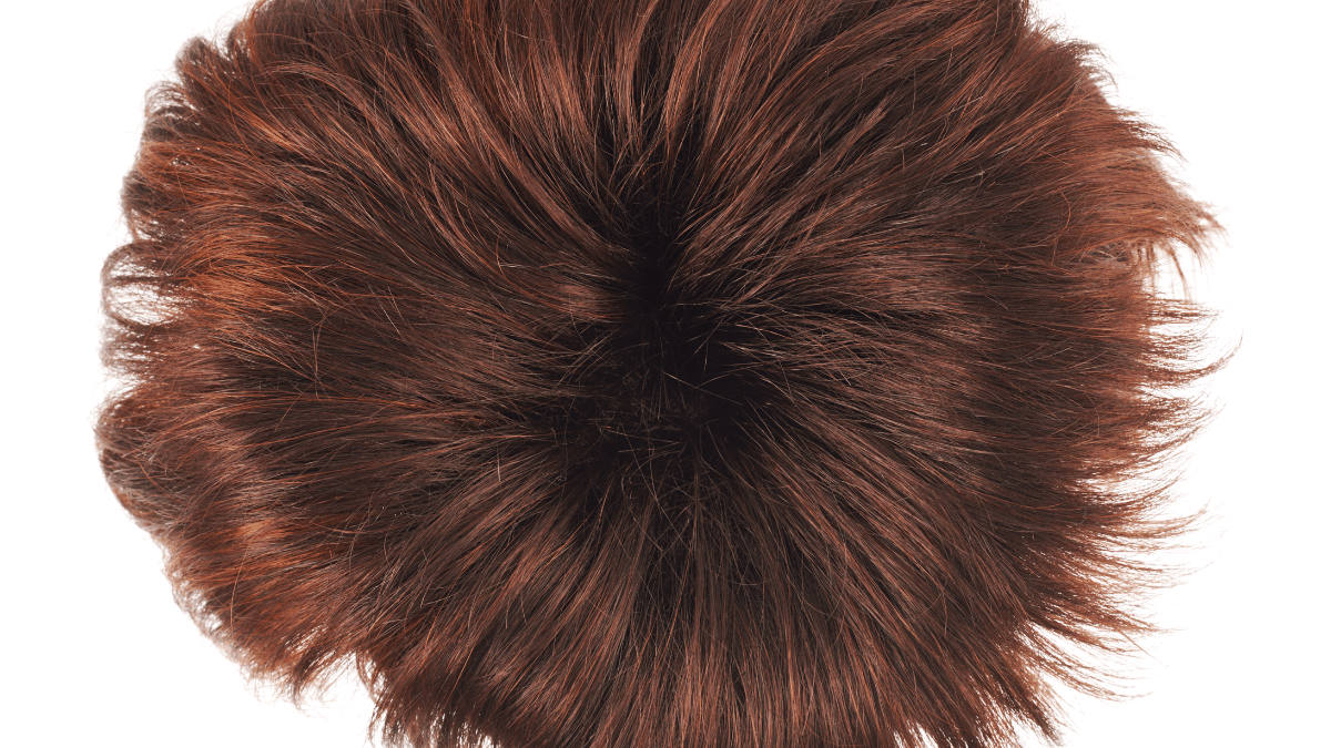 Hair Transplant Surgery vs. Wigs and Hair Patches UnitedCare