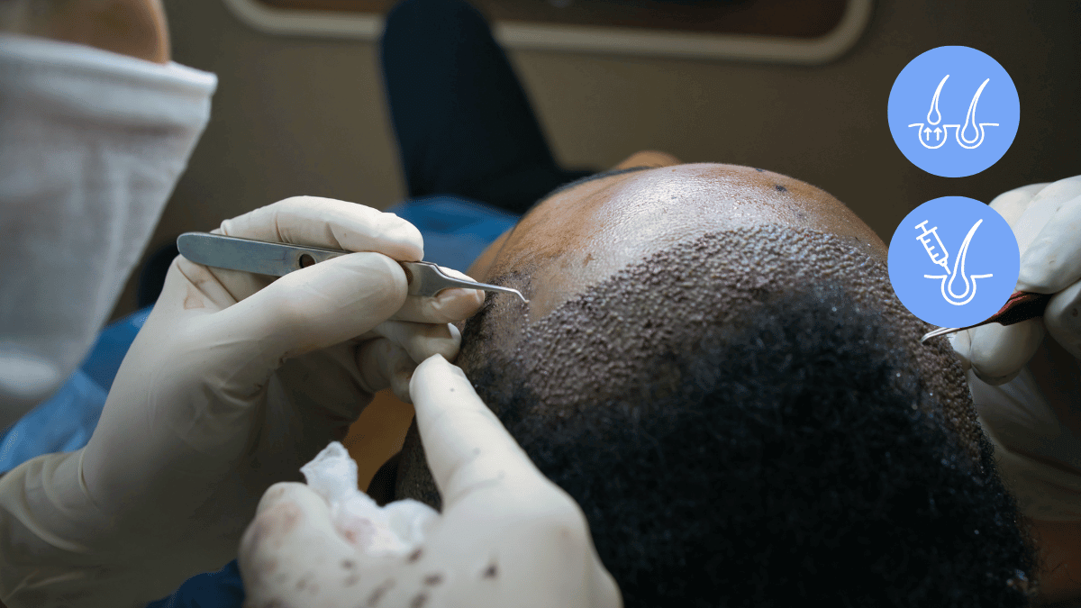 Getting an Unshaven Hair Transplant Is Possible - here’s how