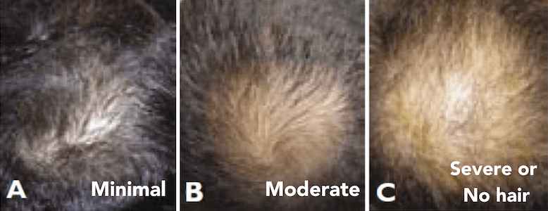 Haarausfall Intensitäten der Haartransplantation Graft-Rechner