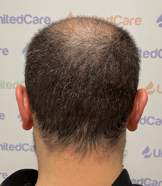 The donor area 1 month after the hair transplant.