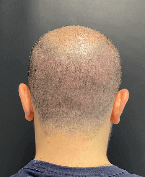 The donor area 1 week after the hair transplant.