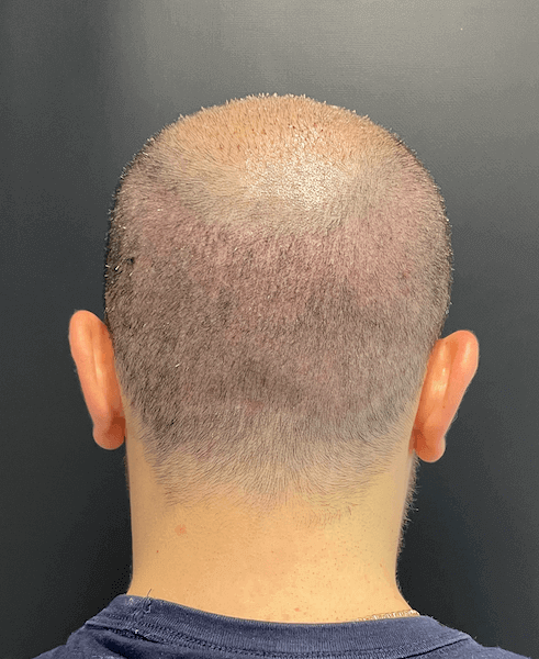 Spenderbereich 1 Woche nach der Haartransplantation