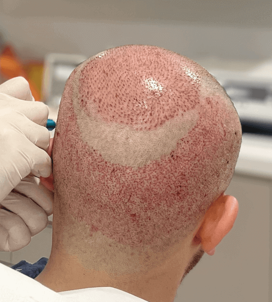 The donor area right after the hair transplant operation