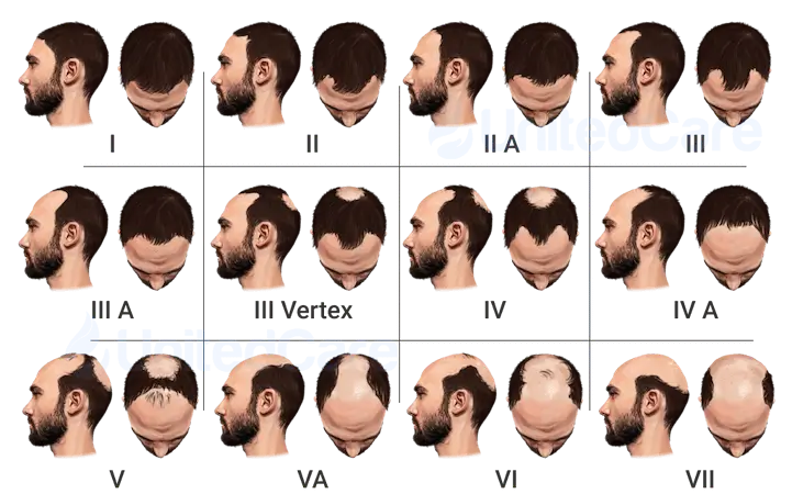 The Hamilton-Norwood Scale for Classification of Male Pattern Baldness