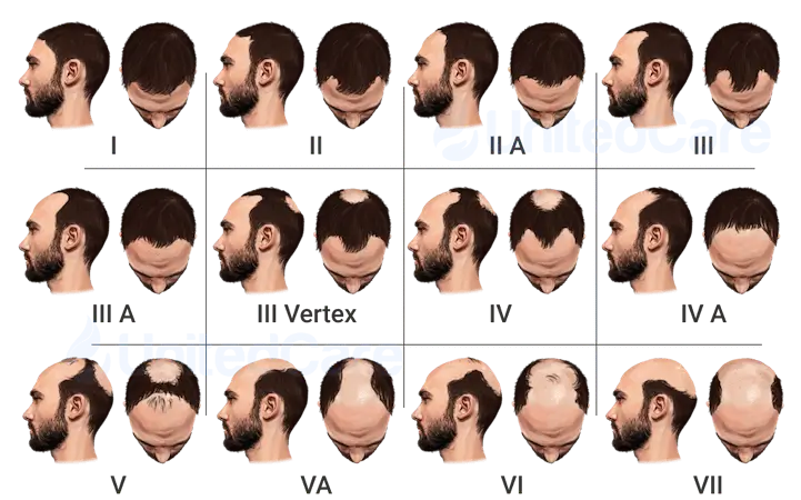 Male pattern balding signs