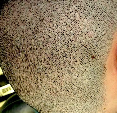 Точечные шрамы после пересадки волос в донорской зоне