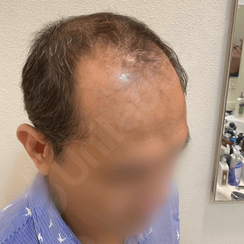 Пациент клиники unitedcare по пересадке волос перед операцией