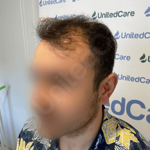 Пациент клиники unitedcare по пересадке волос перед операцией