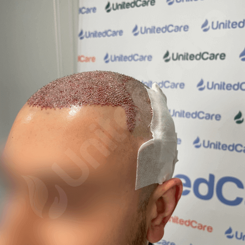 пациент клиники unitedcare по пересадке волос сразу после операции по пересадке 4810 графтов