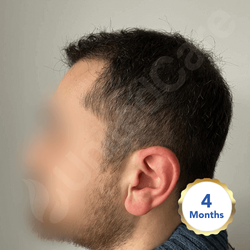 unitedcare hair transplant before after