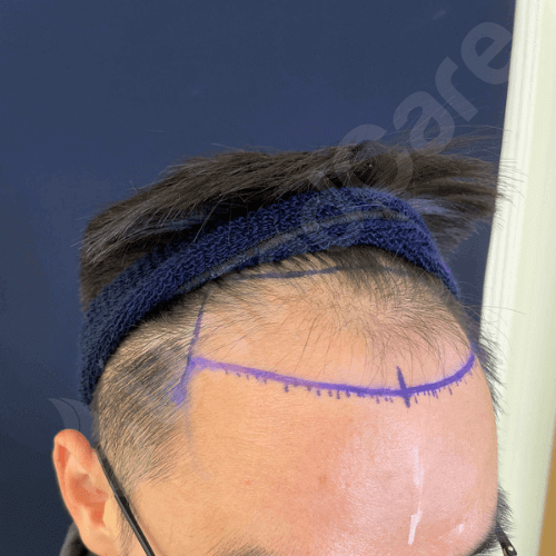unitedcare clinic Haartransplantationspatient vor der Operation
